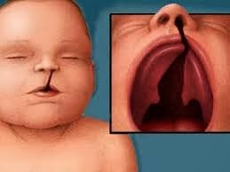 Protesis para bebes con paladar hendido